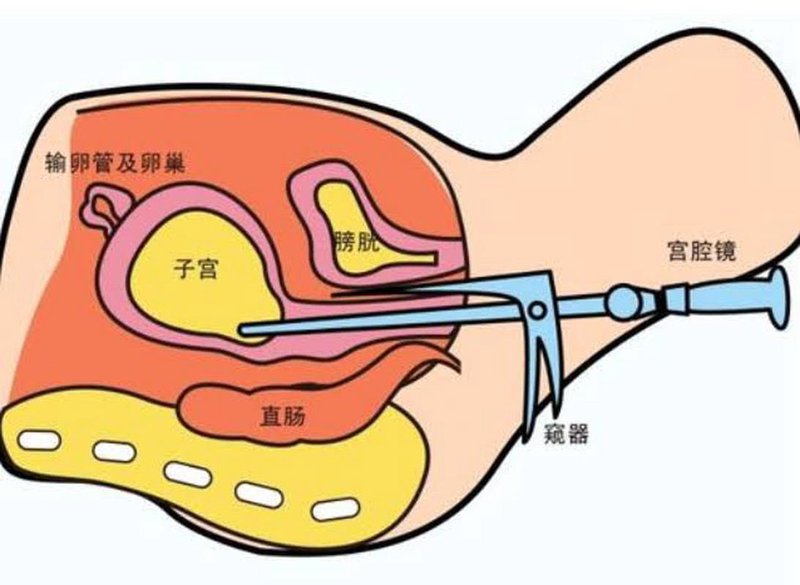 胚胎移植